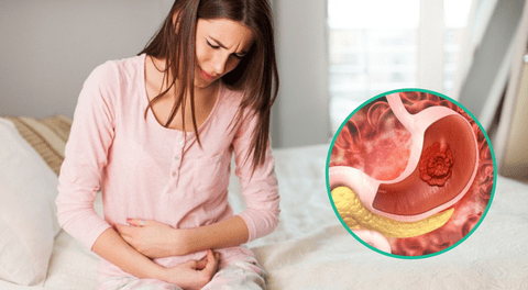 Los síntomas de cáncer de estómago a menudo se confunden con un virus o úlceras estomacales.