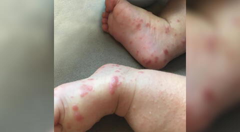 Reportan casos de menores de edad infectados con coxsackie en Sullana.