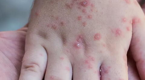 Entre sus principales síntomas está la fiebre y erupciones en la piel.