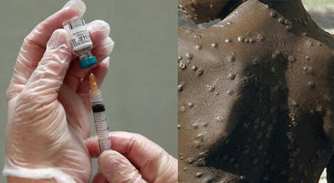 Vacuna contra la viruela sería necesaria para la población, según el INS.