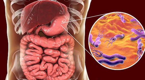 H. pylori: Es un microorganismo al que se le atribuye el desarrollo de cáncer de estómago.