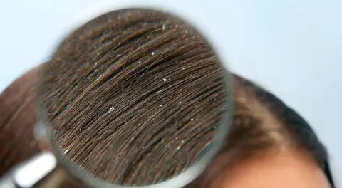 Uno de los problemas que las personas presentan en el cuero cabelludo es la caspa.