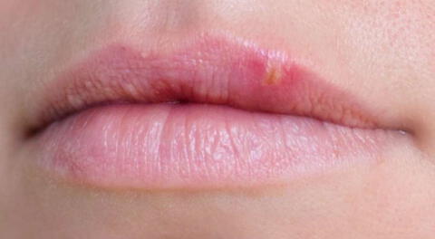 ¿Qué es el "beso de la araña" o Herpes Labial y cómo se cura?