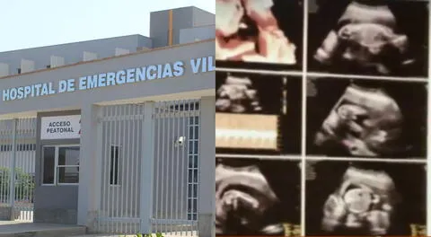El Hospital de Emergencias de Villa El Salvador informó que la paciente llegó con siete meses de embarazo al nosocomio y entro por emergencias a raíz de la pérdida de líquido amniótico.