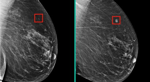 Esta tecnología puede detectar la presencia de células cancerosas en los tejidos mamarios