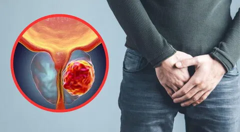 El cáncer de próstata es el cáncer más frecuente en los hombres.