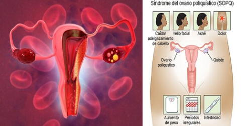 Los ovarios poliquísticos son comunes en la edad reproductiva.