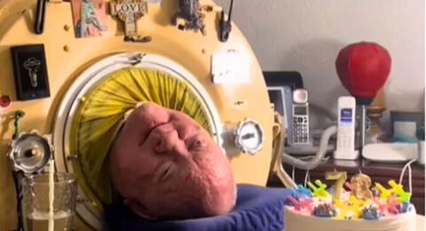 Murió a los 78 años Paul Alexander tras vivir por décadas con un pulmón de acero en Estados Unidos.