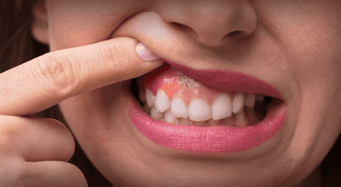 Periodontitis: la enfermedad dental que podría aumentar el riesgo de cáncer de colon.