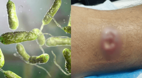 Nuevo caso mortal de la bacteria "come carne" en Florida cifras y zonas.