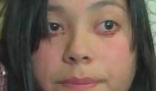 Chica padece de extraño mal que la hace llorar sangre. elpopular.pe