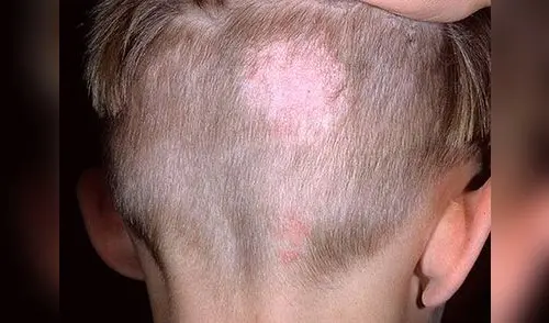 Ataca la tiña de forma natural. elpopular.pe