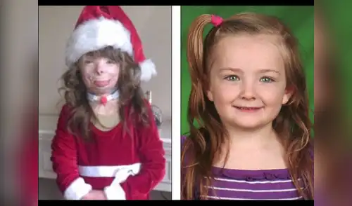 La menor ha sido sometida a 50 cirugías debido al terrible incendio. elpopular.pe