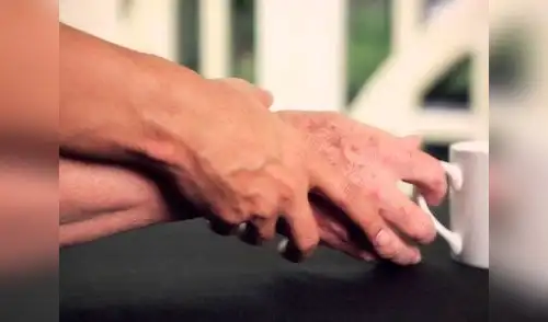 La enfermedad de Parkinson aparece con frecuencia en los adultos mayores, sobre todo en los hombres elpopular.pe