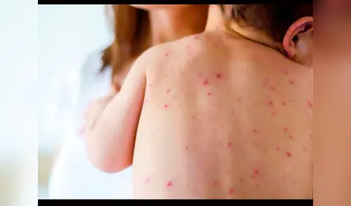 El Ministro de Brasil también confirmo que se han registrado tres muerte por sarampión elpopular.pe