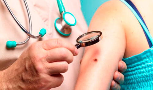 Debemos estar más atentos a los cuidados que necesita nuestra piel, la incorrecta exposición al sol puede generar la aparición de lunares malignos elpopular.pe