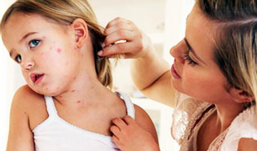 En lo que va del año se ha registrado un caso de sarampión y 1,336 nuevos casos de varicela elpopular.pe