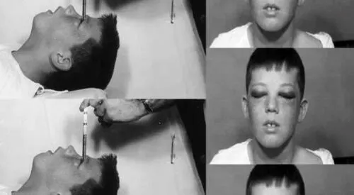 La lobotomía fue calificado en el siglo XX como una cura milagrosa para las enfermedades mentales. elpopular.pe