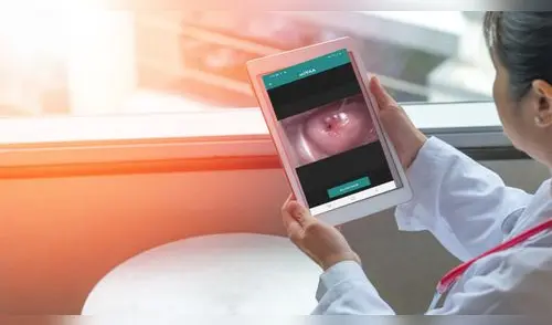 Cáncer de cuello uterino elpopular.pe