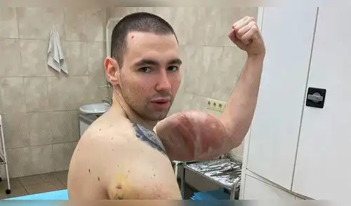 Kirill Tereshin enfrentó una peligrosa cirugía para que no le amputen el brazo elpopular.pe