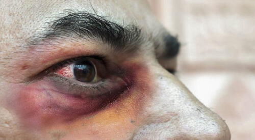 El hongo negro ataca a personas que están en recuperación o se han recuperado del coronavirus. elpopular.pe