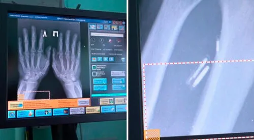 Alexandr Vólchek se colocó el primer dispositivo de este tipo debajo de la piel. elpopular.pe