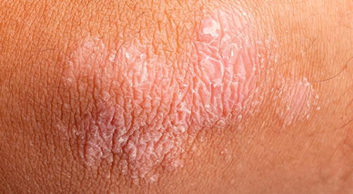 Muchas personas con predisposición a la psoriasis pueden estar libres de síntomas durante años. elpopular.pe