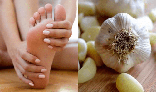 Algunos síntomas de los hongos son enrojecimiento y descamación de la piel. elpopular.pe