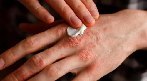 Eczema es un término que designa varios tipos distintos de hinchazón de la piel. elpopular.pe