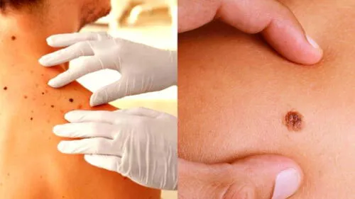 Sospecha de los lunares que tienen un crecimiento excesivo. elpopular.pe