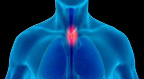 Síntomas del cáncer de esófago en la etapa inicial. elpopular.pe