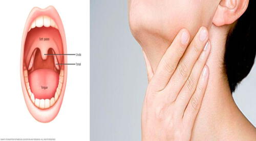 El cáncer de amígdalas tiene síntomas a los que debes prestarle atención. elpopular.pe