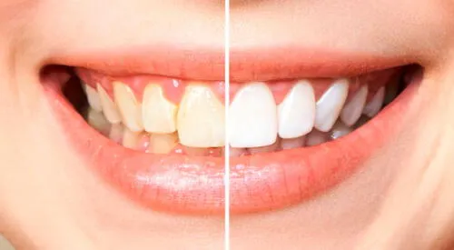 Trucos caseros para blanquear los dientes con remedios naturales elpopular.pe