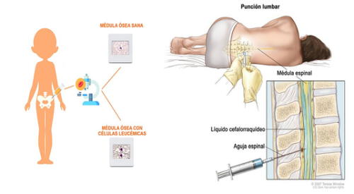 Deben estar muy atentos a los síntomas de la leucemia linfoblástica aguda infantil elpopular.pe