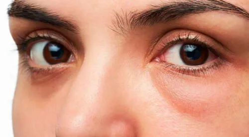 Remedios caseros para las ojeras elpopular.pe