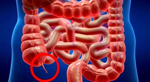 Cuando se órgano se inflama se genera una apendicitis. elpopular.pe