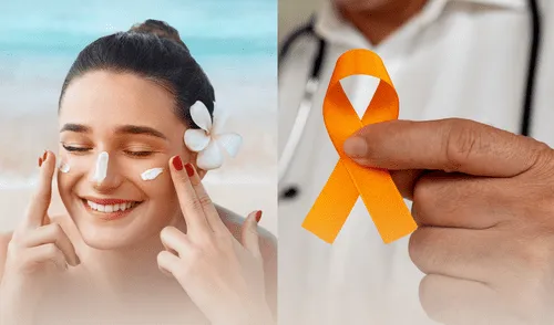 Las quemaduras solares son una de las prinicipales causas de cáncer de piel. elpopular.pe