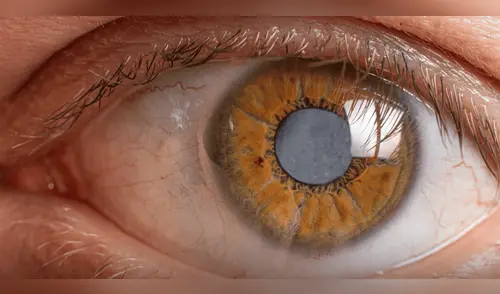 EMR: el tratamiento sin láser ni cirugía que podría cambiarlo todo. elpopular.pe