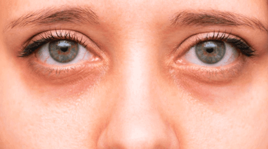 How many types of dark circles are there?