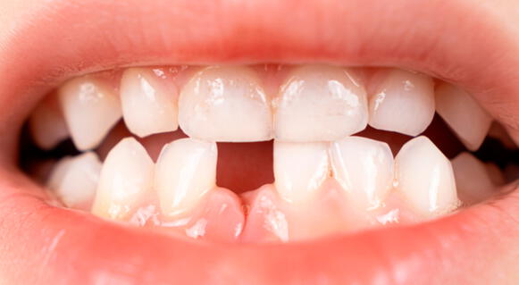 Dientes de leche