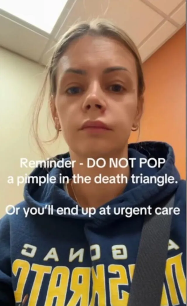 Mujer se reventó un acné en la zona de l triangulo de la muerte en el rostro. Mujer se reventó un acné en la zona de l triangulo de la muerte en el rostro.