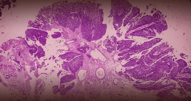 El veneno de escorpión aporta una posible cura para el cáncer. El veneno de escorpión aporta una posible cura para el cáncer.