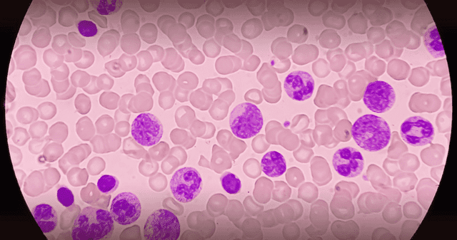 Investigadores presentan prueba sanguínea para diagnosticar distintos tipos de cáncer. Investigadores presentan prueba sanguínea para diagnosticar distintos tipos de cáncer.