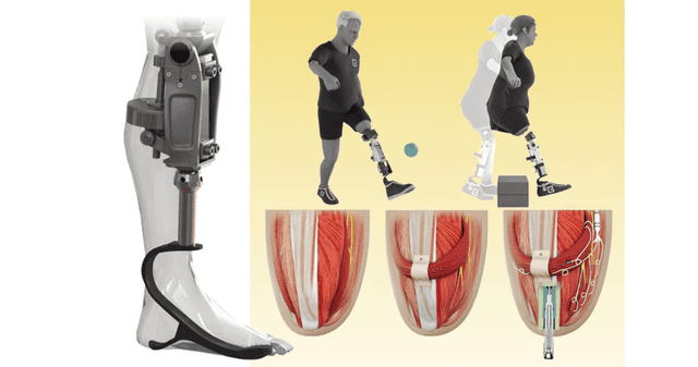 Rodilla biónica del MIT promete devolver movilidad y autonomía a pacientes en recuperación. Rodilla biónica del MIT promete devolver movilidad y autonomía a pacientes en recuperación.