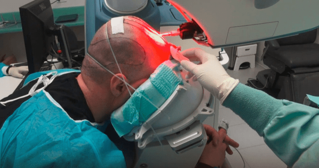 ¿Cómo funciona ARTAS iX, el robot que te devuelve el cabello?