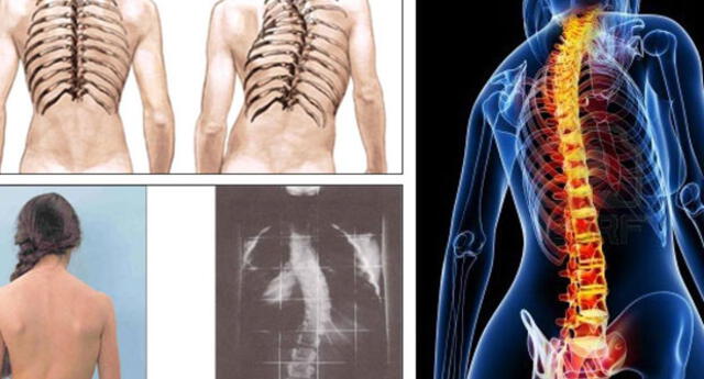 Escoliosis La Importancia De Detectarla A Tiempo Para 0226