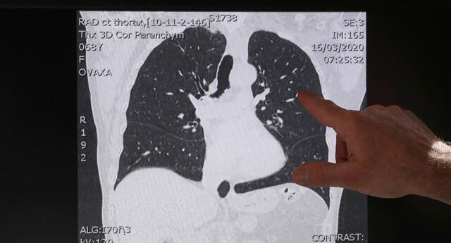 Coronavirus: ¿Cómo afecta el COVID-19 en los pulmones y a nuestro organismo? Coronavirus: ¿Cómo afecta el COVID-19 en los pulmones y a nuestro organismo?