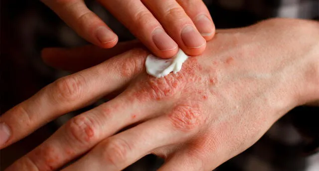 Eczema es un término que designa varios tipos distintos de hinchazón de la piel.