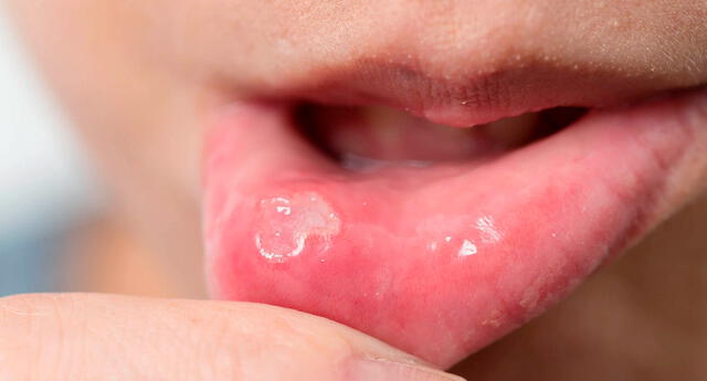Causas de las úlceras en la boca