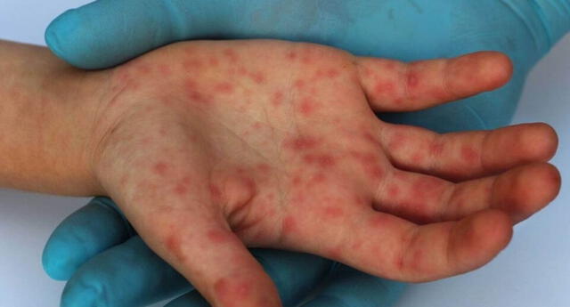 Síntomas de viruela del mono: cómo reconocer la enfermedad y qué tan  peligrosa es | El Popular